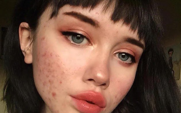 دانشمندان داروی جدید قدرتمندی برای درمان آکنه ساختهاند