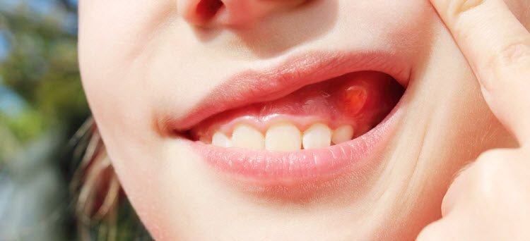 آبسه دندان کودکان چقدر طول میکشد؟