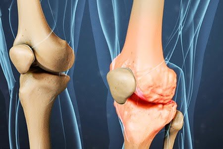درمان قطعی آرتروز زانو: بررسی جدیدترین درمانهای بدون جراحی و خانگی