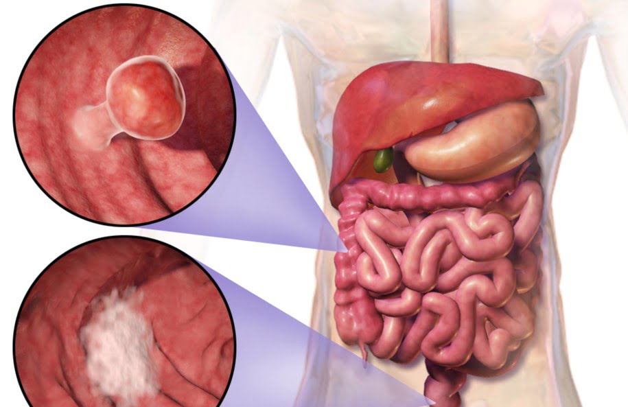 دانشمندان یک «نقشه راه» برای چیره شدن بر سرطان روده را کشف کردهاند