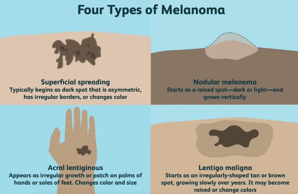 مرگبارترین شکل سرطان پوست (در دنیا و به صورت کلی) ملانوما نیست!