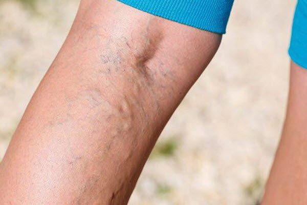 بیماری واریس چیست و در کدام نقاط بدن ظاهر می شود؟