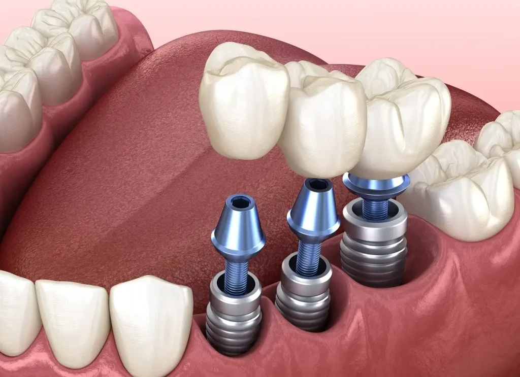 ایمپلنت دندان راه حل دائمی برای جایگزینی دندان از دست رفته
