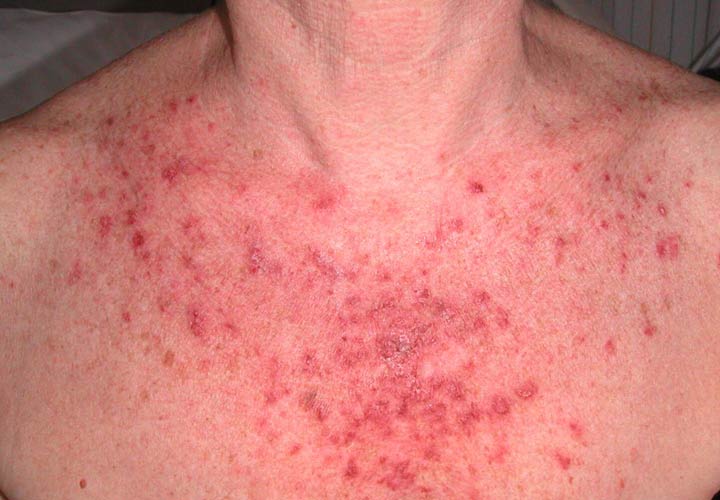 علائم متداول لوپوس چیست؟