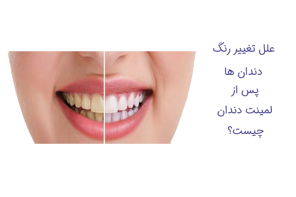 علت تغییر رنگ دندان بعد لمینت
