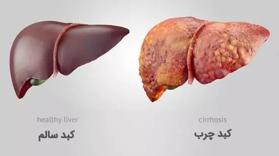 یک بررسی جامع بر بیماریهای کبد: علتها، علائم، تشخیص و درمان