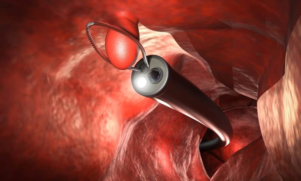 ۳ نکتهای که باید در مورد پولیپ روده بدانید