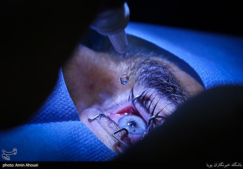 عمل تغییر رنگ چشم عوارض خطرناکی دارد