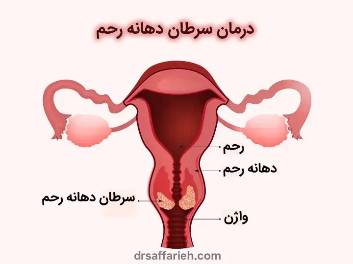 درمان سرطان دهانه رحم