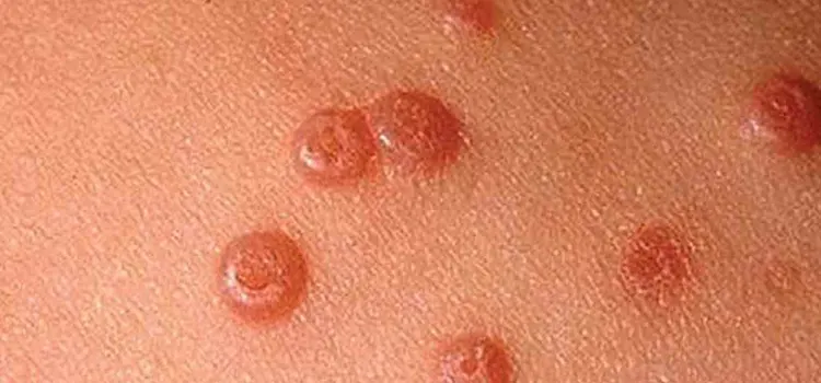 زگیل تناسلی